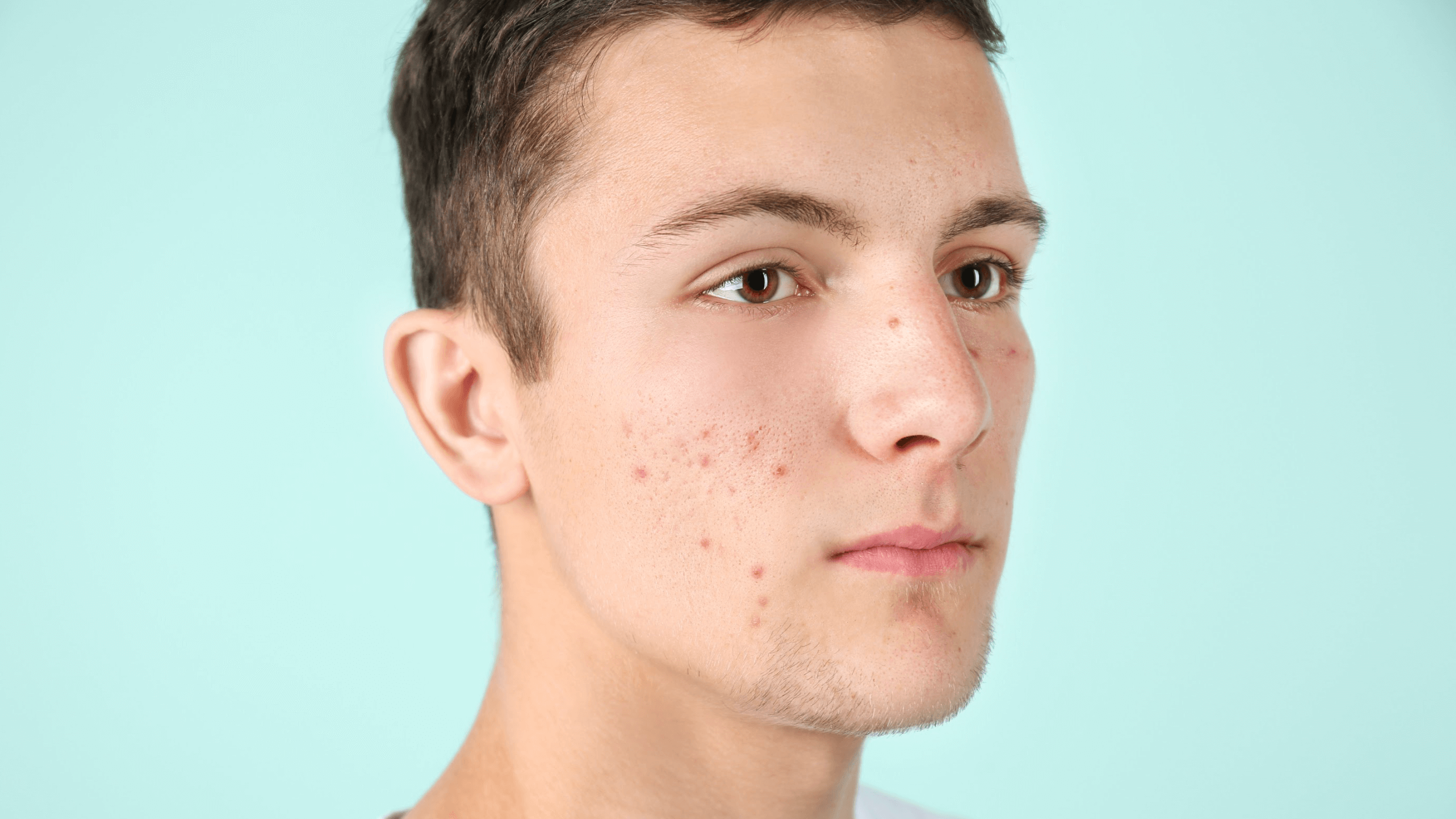 AviClear is the Clear Choice for Mild to Severe Acne